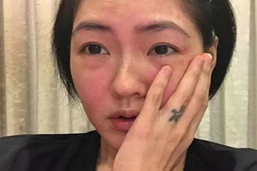 換季皮膚過敏怎么辦？六大致敏誤區!